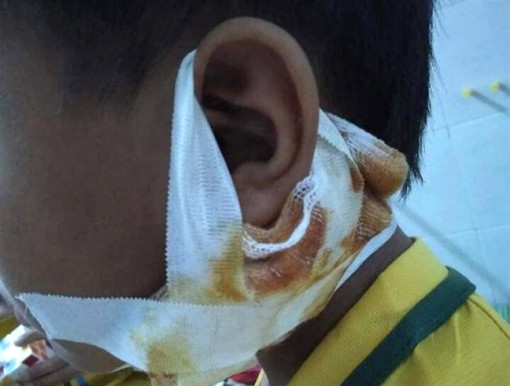 Thêm một trẻ ở Nghệ An nhiễm ‘vi khuẩn ăn mòn cơ thể’