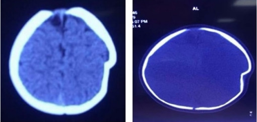 Bé 8 tháng tuổi lún sọ não khi chơi một mình trên xe tập đi