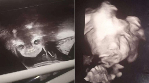 Người mẹ hốt hoảng khi siêu âm thấy thai nhi tươi cười