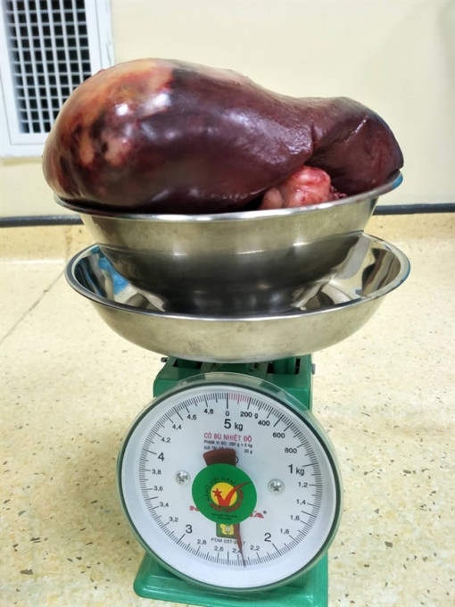 Đau tức ở sườn trái, cô gái 24 tuổi bất ngờ phát hiện bị ung thư lách