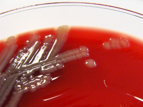 Vi khuẩn Whitmore đang bị nhầm lẫn với vi khuẩn ăn thịt người