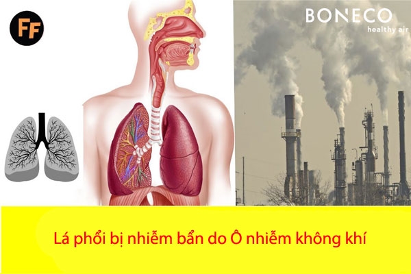 30% truong hop tu vong do ung thu phoi co lien quan toi o nhiem khong khi