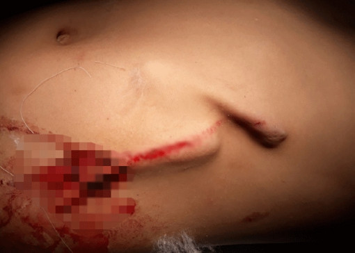 Cỏ voi dài 20cm đâm xuyên bụng bé trai 8 tuổi