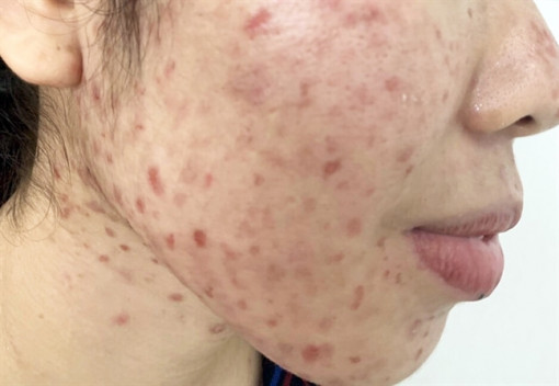 Bệnh hiếm: Nghiện dùng kim đâm da mặt chảy máu