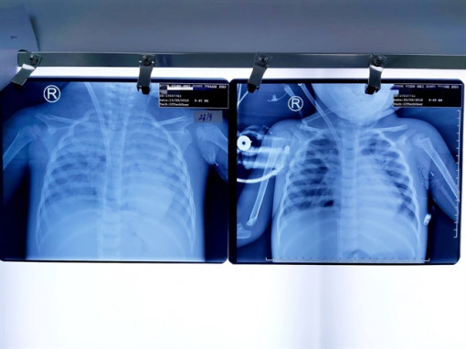 Bé gái gần 3 tuổi được cứu sống nhờ phương pháp thở không cần tim, phổi