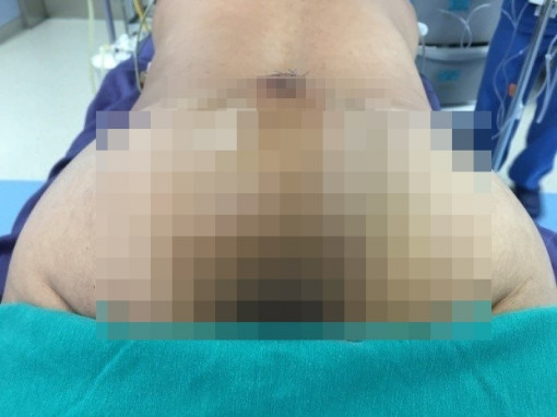 U khổng lồ mọc ngay mông khiến nam bệnh nhân không thể ngồi hay nằm suốt 1 năm