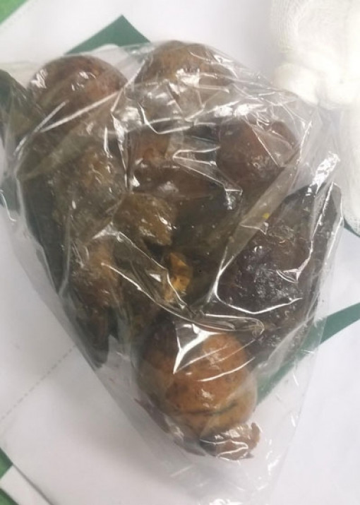 Dạ dày của bệnh nhân ở Quảng Ninh chứa toàn hạt xoài, đồng xu