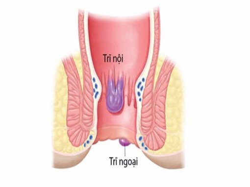 Bệnh nhân hoại tử hậu môn do tự chữa trĩ bằng thuốc nam