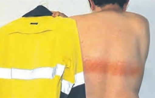 Nam kỹ sư bị phỏng do mặc áo phản quang dưới trời nắng