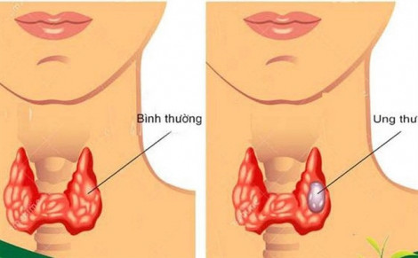 Bé 3 tuổi bị ung thư tuyến giáp di căn nhưng người nhà tưởng con khó thở