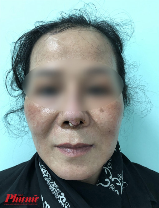 Căng da mặt níu kéo tuổi xuân, chưa kịp trẻ đã liệt mặt