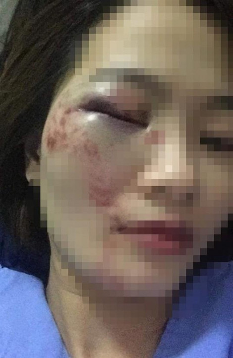 Bị nhắc nhở, nhóm 4 thanh niên đánh nữ nhân viên xe buýt bầm mắt