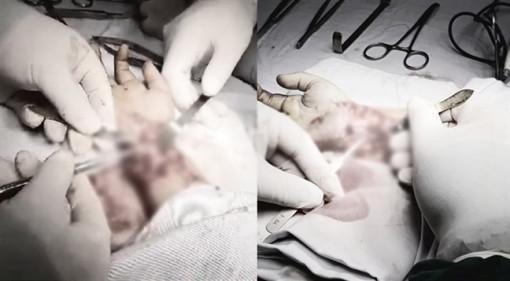 Té trong phòng tắm, cậu bé 6 tuổi bị viên gạch vỡ cắt gần đứt lìa cổ tay