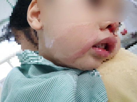 Lấy nhầm axít tẩy nốt ruồi nhỏ vào mũi con trai 2 tuổi gây bỏng nặng