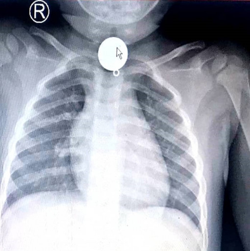 Bé trai 2 tuổi ở Sài Gòn cứu sống mình nhờ chỉ tay vào cổ họng ra dấu cho cô giáo giữ trẻ