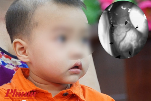 U hiếm gặp gây lồi mắt trái bé trai 15 tháng tuổi