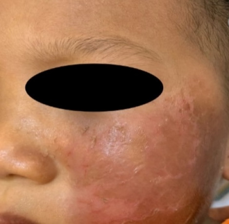 Cậu bé 4 tuổi ở Sài Gòn phồng rộp da mặt khi đeo mặt nạ siêu nhân chơi Halloween