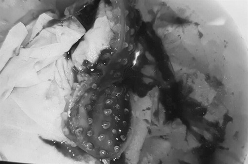 Xấu hổ nên không đến bệnh viện sớm, cô gái phải lên bàn mổ lấy bao cao su ra ngoài