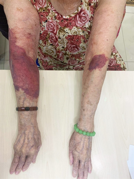 Mắc hội chứng 'da giấy' do sử dụng thuốc bừa bãi