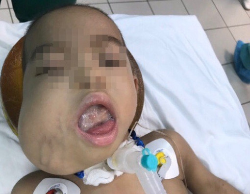 Cuộc hội chẩn xuyên biên giới giữa Pháp, Mỹ và Việt Nam để cứu bé gái thoát khỏi u quái chèn lưỡi hiếm gặp