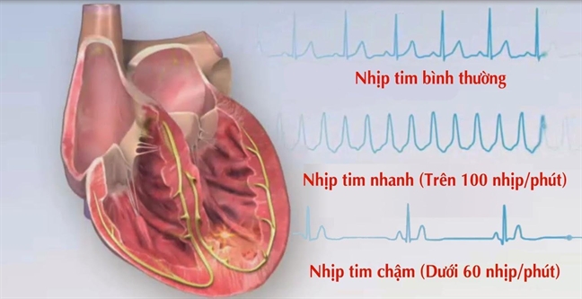 Cay chip theo doi nhip tim sieu nho, co hoi cho benh nhan tai bien