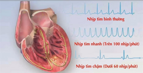 Cấy chíp theo dõi nhịp tim siêu nhỏ, cơ hội cho bệnh nhân tai biến