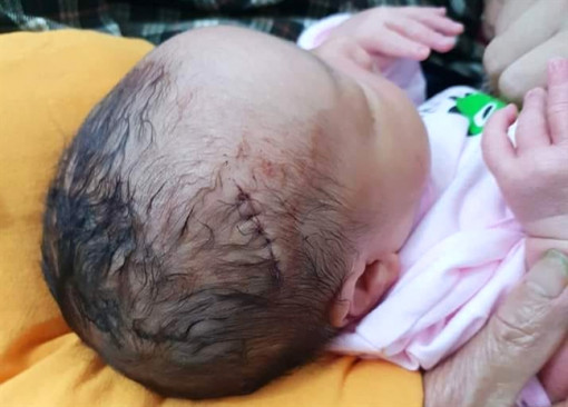 Bác sĩ đỡ đẻ làm rách đầu bé trai phải khâu 6 mũi
