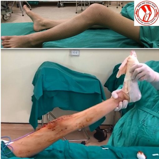 Thay khớp gối giúp nữ sinh 16 tuổi bị ung thư xương đi lại trên đôi chân của mình