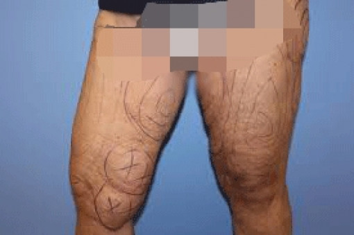 Đi hút mỡ, người đàn ông bị mưng mủ ở cả 2 bên đùi