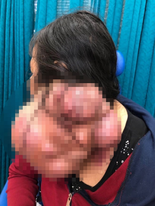 Bác sĩ Chợ Rẫy giải cứu người phụ nữ có ‘2 đầu’