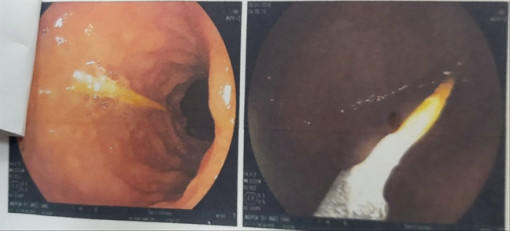 Bắt chước người lớn ngậm tăm, bé gái 1 tuổi nuốt luôn vào bụng