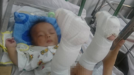 Nghi vấn bé 4 tháng tuổi bị cha đánh gãy chân, xuất huyết não