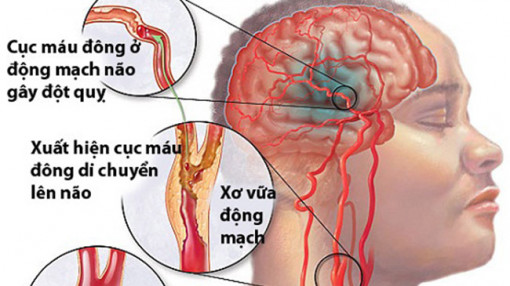 Chế độ ăn uống ảnh hưởng đến các loại đột quỵ khác nhau