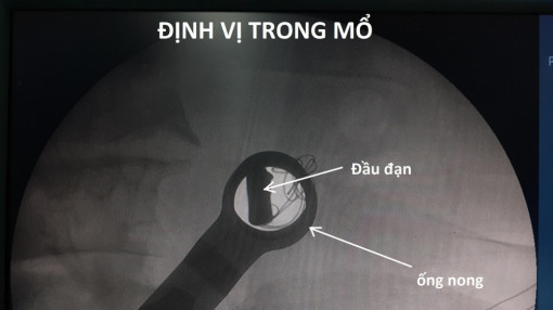 Mổ lấy viên đạn nằm hơn 50 năm trong người một cựu chiến binh