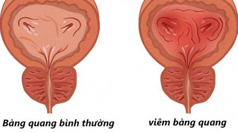 Đi tiểu hơn 20 lần/ngày có trị hết?