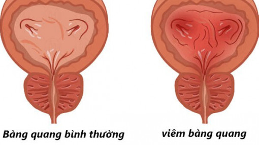 Đi tiểu hơn 20 lần/ngày có trị hết?