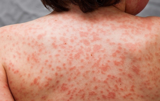 Anh: 100 trẻ em mắc bệnh lạ liên quan đến COVID-19, cảnh báo về dịch mới