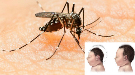 Bộ Y tế công bố nam thanh niên 25 tuổi ở Đà Nẵng mắc Zika