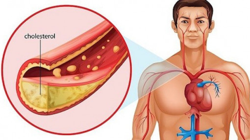 Vì sao người gầy bị máu nhiễm mỡ?