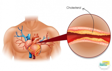 Clip: Cholesterol xấu gây đột quỵ như thế nào?