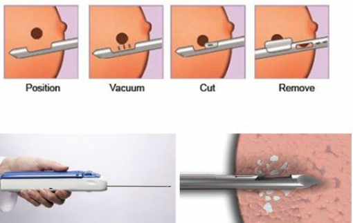 Hút chân không để điều trị ung thư vú?