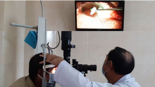 Keo dán sắt văng vào mắt gây bỏng giác mạc
