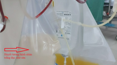 Bệnh nhân 43 tuổi bị máu trắng đục như sữa, rơi vào viêm tụy cấp