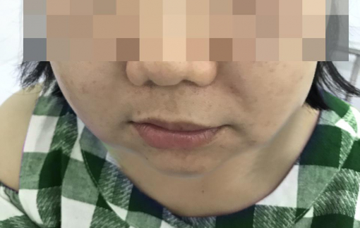 Bác sĩ da liễu "lật tẩy" việc "mông má" tế bào gốc gây biến chứng cho phụ nữ