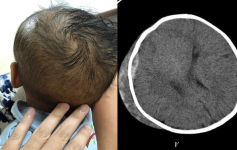 Sưng đầu do ngã xe tập đi, bác sĩ phát hiện bé 6 tháng tuổi có khối máu tụ nguy hiểm