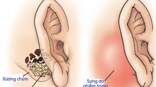 Viêm xương chũm không chữa, 40 con giòi làm ổ trong tai