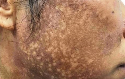 Da mặt loang lổ trắng, đen vì tin lời hứa của spa