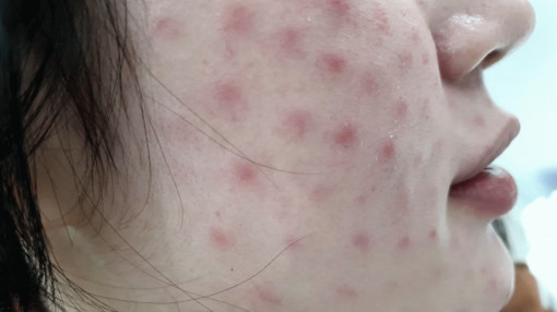 Tiêm chất chống già, chưa trẻ ra đã vào viện