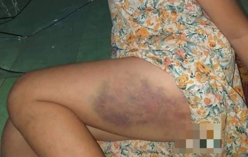 Một học sinh lớp 3 bị cô giáo đánh bầm đùi