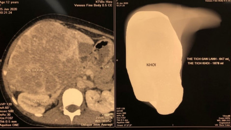 Bé 12 tuổi đi khám bụng to, phát hiện ung thư gan